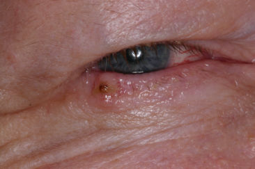 Pre-op basal cell carcinoma right lower eyelid