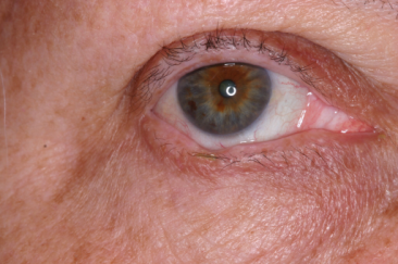 Pre-op Basal Cell Carcinoma right lower eyelid