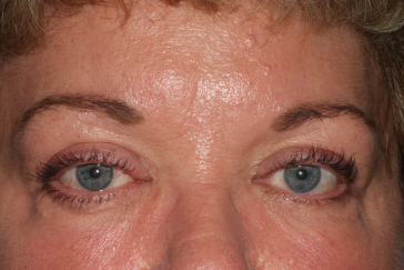 Female post-op ptosis and brow lift with improved lid and brow position