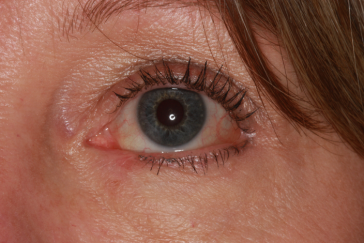 Pre-op basal cell carcinoma left lower eyelid