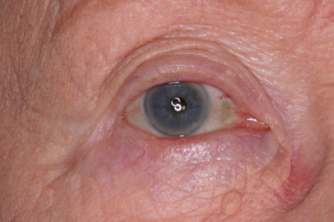 Pre-op Basal cell carcinoma right lower eyelid
