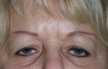 Female pre-op ptosis and blepharoplasty with drooping upper eyelids and excess skin
