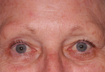 Female post-op blepharoplasty and brow lift with improved lid and brow position