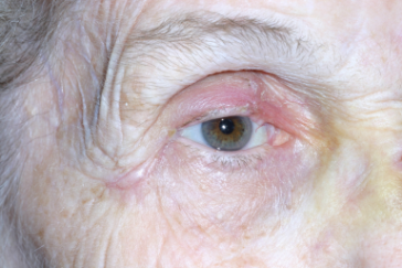 Post-op 3 months after semicircular flap repair right upper eyelid