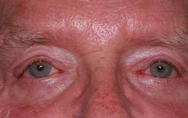 Male post-op ptosis and blepharoplasty with improved eyelid height and reduced eyelid fullness