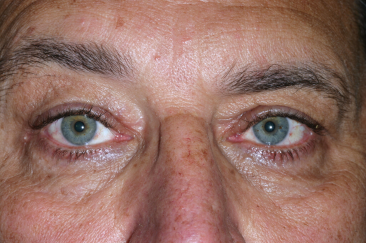 Male post-op ptosis and blepharoplasty with improved eyelid position