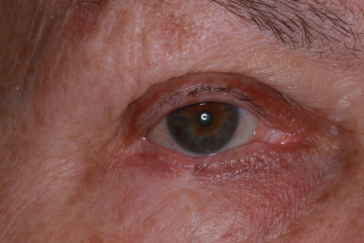 Post-op 1 year right lower eyelid reconstruction