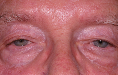 Male pre-op ptosis and blepharoplasty with excess upper eyelid skin and drooping eyelids as well as lower eyelid fullness