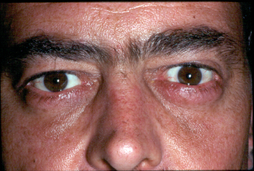 After Retraction Repair, post-op with improved position