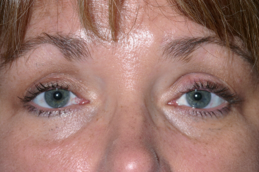 Female post-op ptosis with improved upper eyelid height