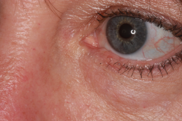 Post-op 3 months left lower eyelid reconstruction