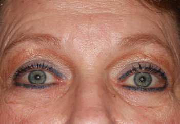 Female post-op blepharoplasty and brow lift with improved lid and brow position