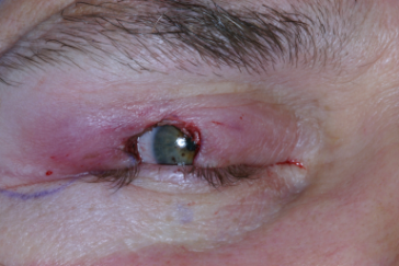 Intraoperative photograph Mohs' defect reconstruction with semicircular flap