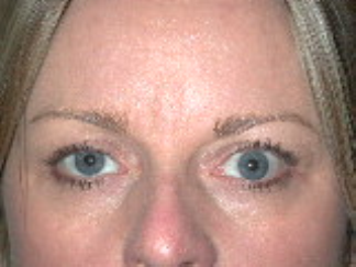 Left Upper Eyelid Retraction, pre-op