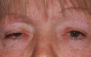 Female pre-op ptosis with drooping upper eyelids