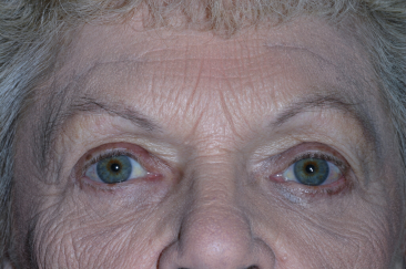 Female post-op ptosis and blepharoplasty with improved eyelid height