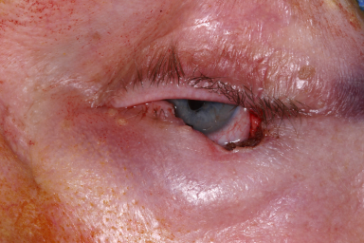 Left lower eyelid Mohs' defect