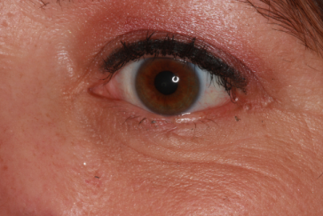 Post-op 10 weeks left lower eyelid after reconstruction