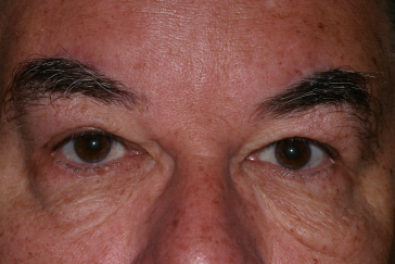 Male post-op brow lift with improved brow position