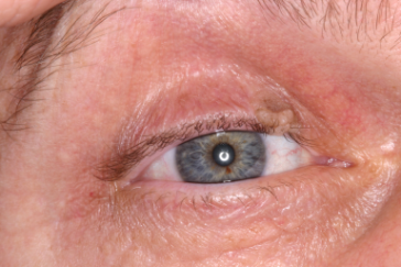 Pre-op right upper eyelid seborrheic keratosis