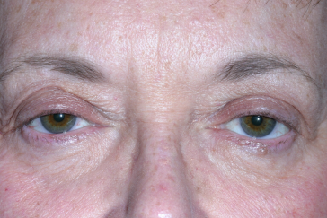 Female pre-op ptosis with drooping upper eyelids