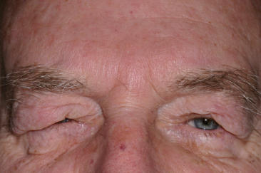 Male pre-op blepharoplasty, ptosis repair and brow lift with severe drooping of upper eyelids and excess skin