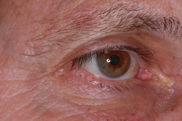 Pre-op Basal cell carcinoma (occult) right lower eyelid