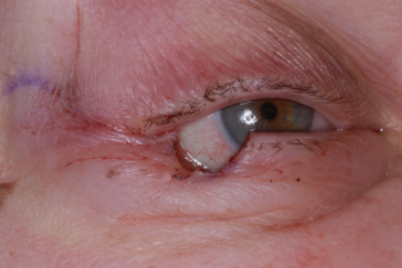 Right lower eyelid defect with semicircular flap