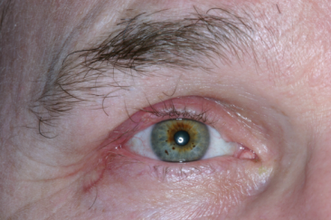 Post-op 6 weeks right upper eyelid