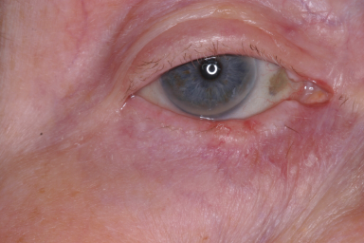 Pre-op basal cell carcinoma right lower eyelid