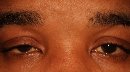 Male pre-op ptosis with drooping eyelids