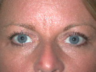 Left upper eyelid after Retraction Repair