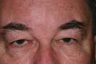 Male pre-op brow lift with brow descent