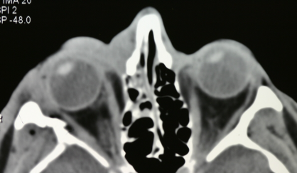 Axial CT showing right zygoma fracture