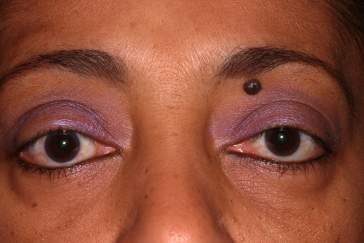 Post-op right upper eyelid retraction repair