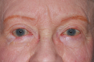 Post-operative 3 month right lower eyelid