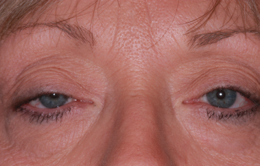 Female pre-op ptosis repair and upper and lower blepharoplasty with drooping upper eyelids and skin excess