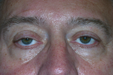 Male pre-op ptosis repair with drooping eyelids