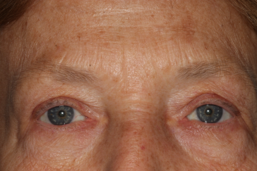 Female post-op blepharoplasty and brow lift with improved lid and brow position