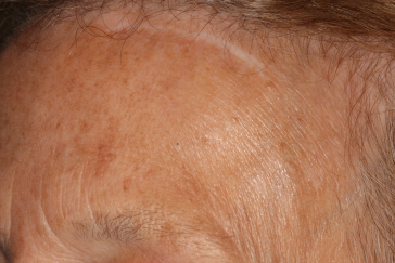Left Side Pretrichial Scar