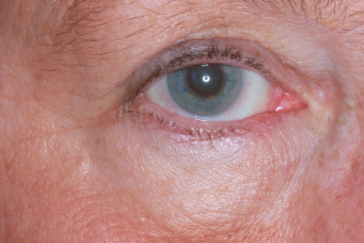 Post-op 3 months right lower eyelid reconstruction