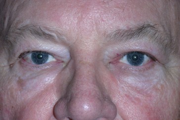 Male post-op ptosis repair with improved left eyelid
