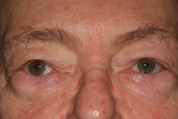 Male post-op ptosis with improved eyelid height