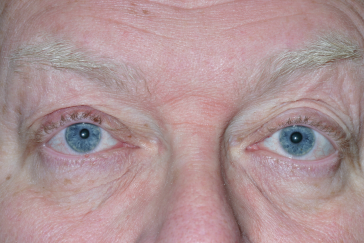 Male post-op ptosis repair with improved eyelid position