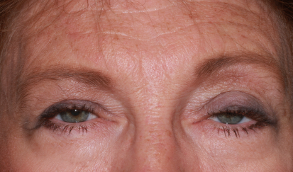 Female pre-op ptosis and upper and lower blepharoplasty with drooping eyelids and eyelid fullness