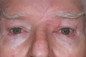 Post-op 3 month left upper eyelid reconstruction