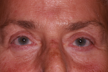 Female post-op blepharoplasty and brow lift with improved lid and brow position and a reduction in lower lid puffiness