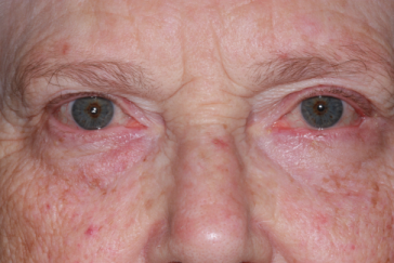 Post-op 3 months left lower eyelid reconstruction