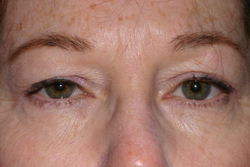 Female pre-op ptosis and blepharoplasty with drooping eyelids and excess skin