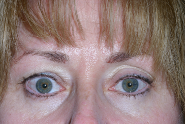 Right Upper Eyelid Retraction, pre-op